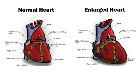 cardiomegaly is most similar to cardiac blank|enlarged ventricles heart.